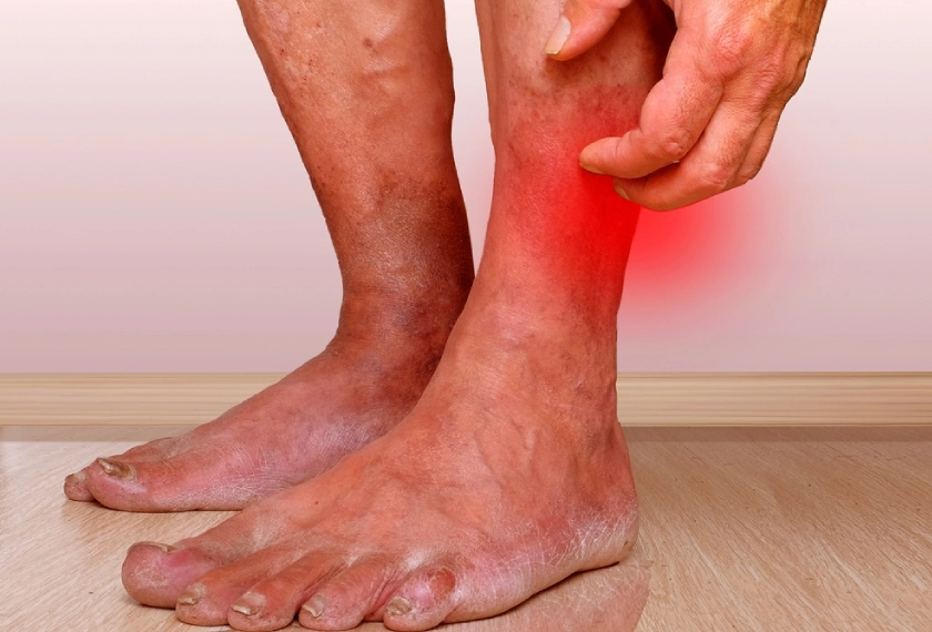 Venous Ulcers
